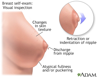 Monthly breast selfexams should always include visual inspection with and 