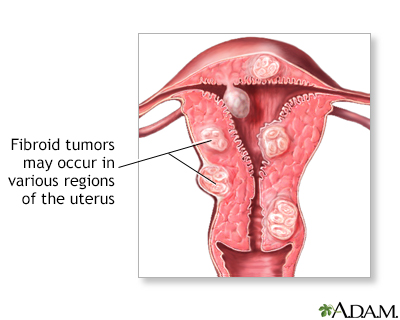 Fibroid tumors may not need to be removed if they are not causing pain ...